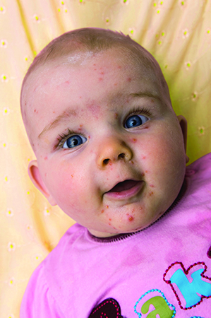 Infections (eg chicken pox, slapped cheek disease, whooping cough)