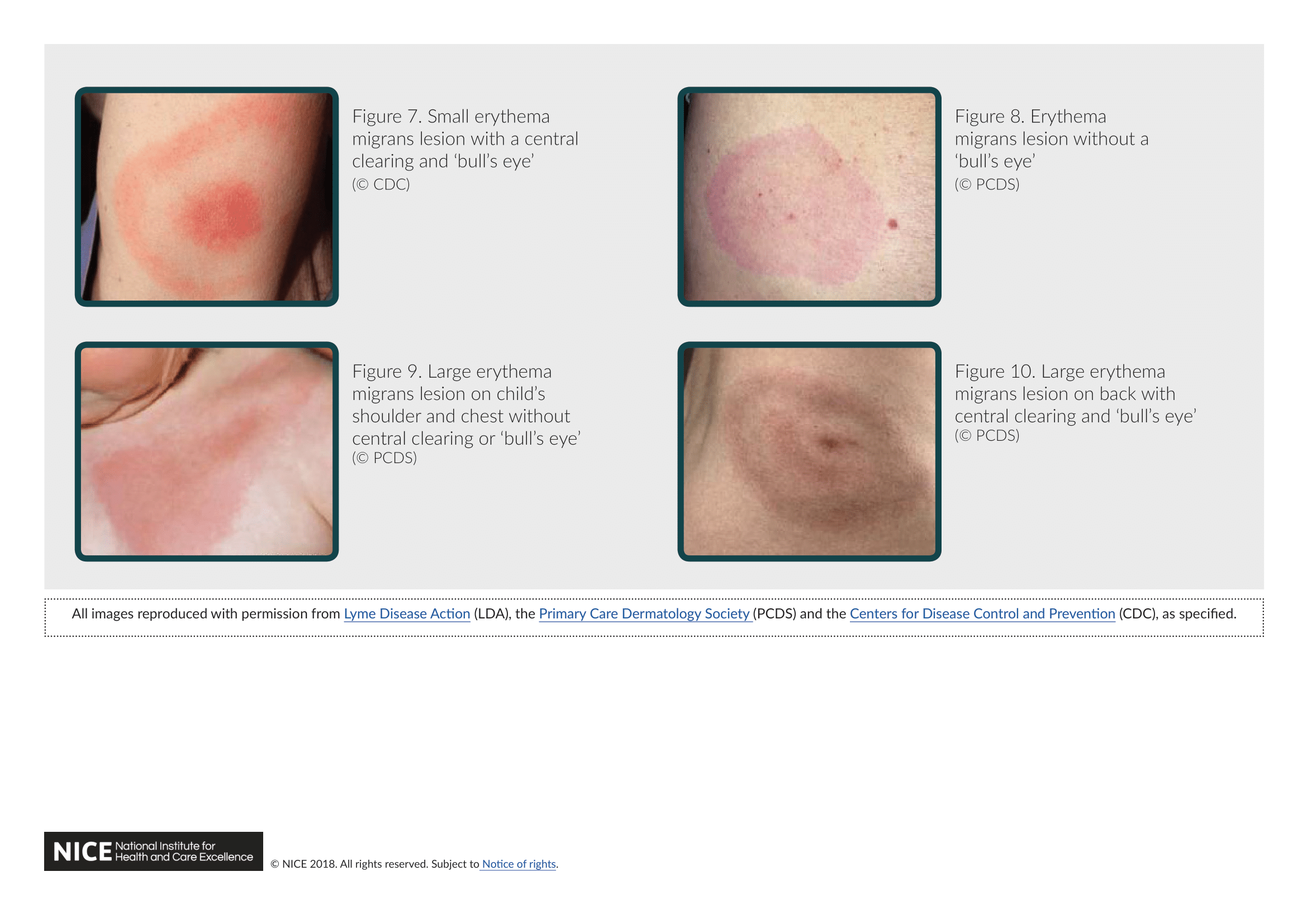 lyme disease series of pictures