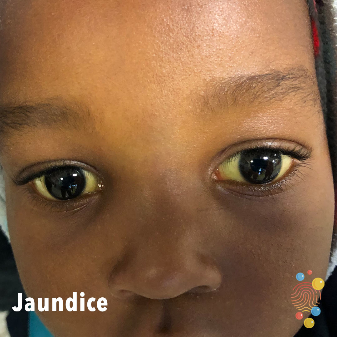 Yellow Jaundice In Babies