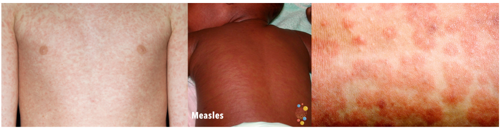 Three images of child's bodies showing the rash. To the left it is a white body with a mottled looking rash across the whole torso. the middle is a black child with slight small raised bumps. The right is a white torso with psoriasis-like rash