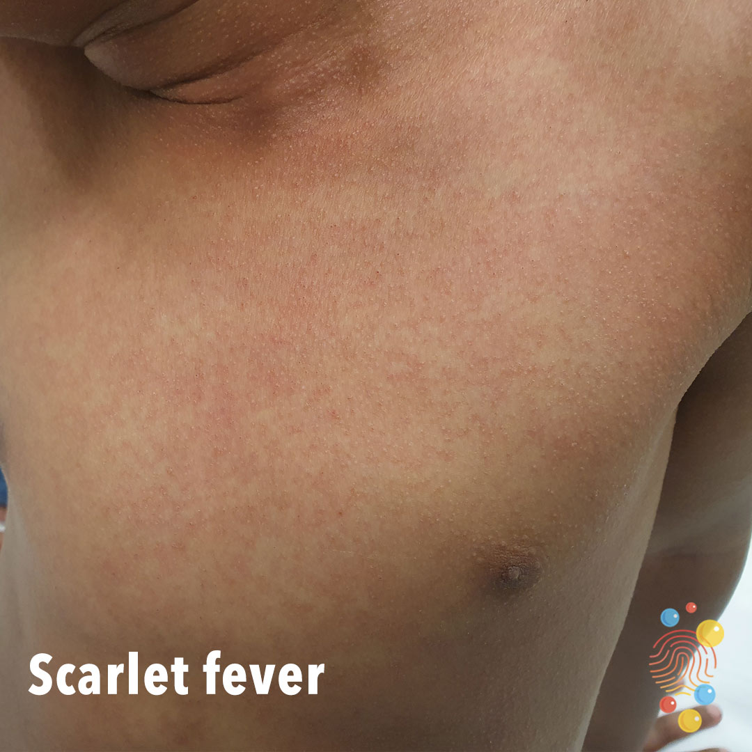 Strep A and Scarlet Fever :: Healthier Together