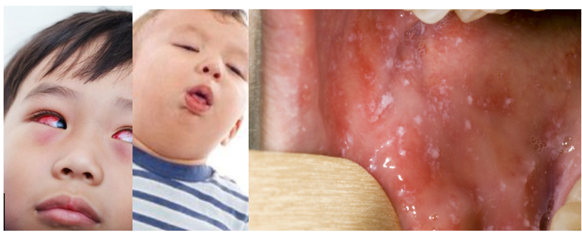 Three images of some measles symptoms. On the left, a child with red bloodshot eyes, in the middle a child with a swelling and a cough, on the right a mouth showing a series of white spots on the tongue