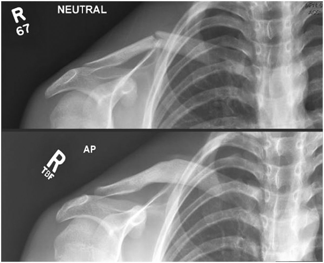 Clavicle fractures