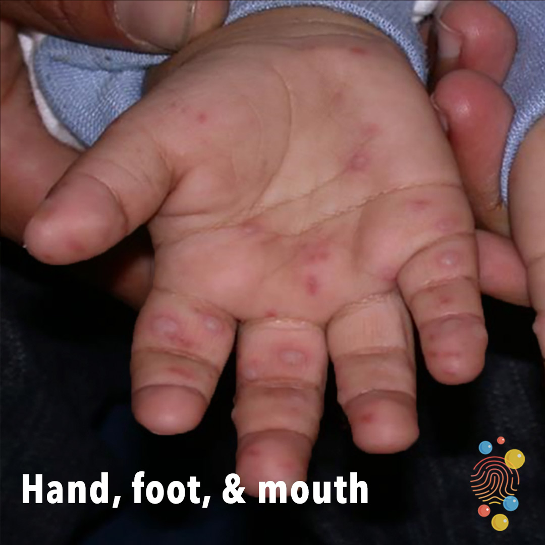 Hand, foot and mouth disease Healthier Together