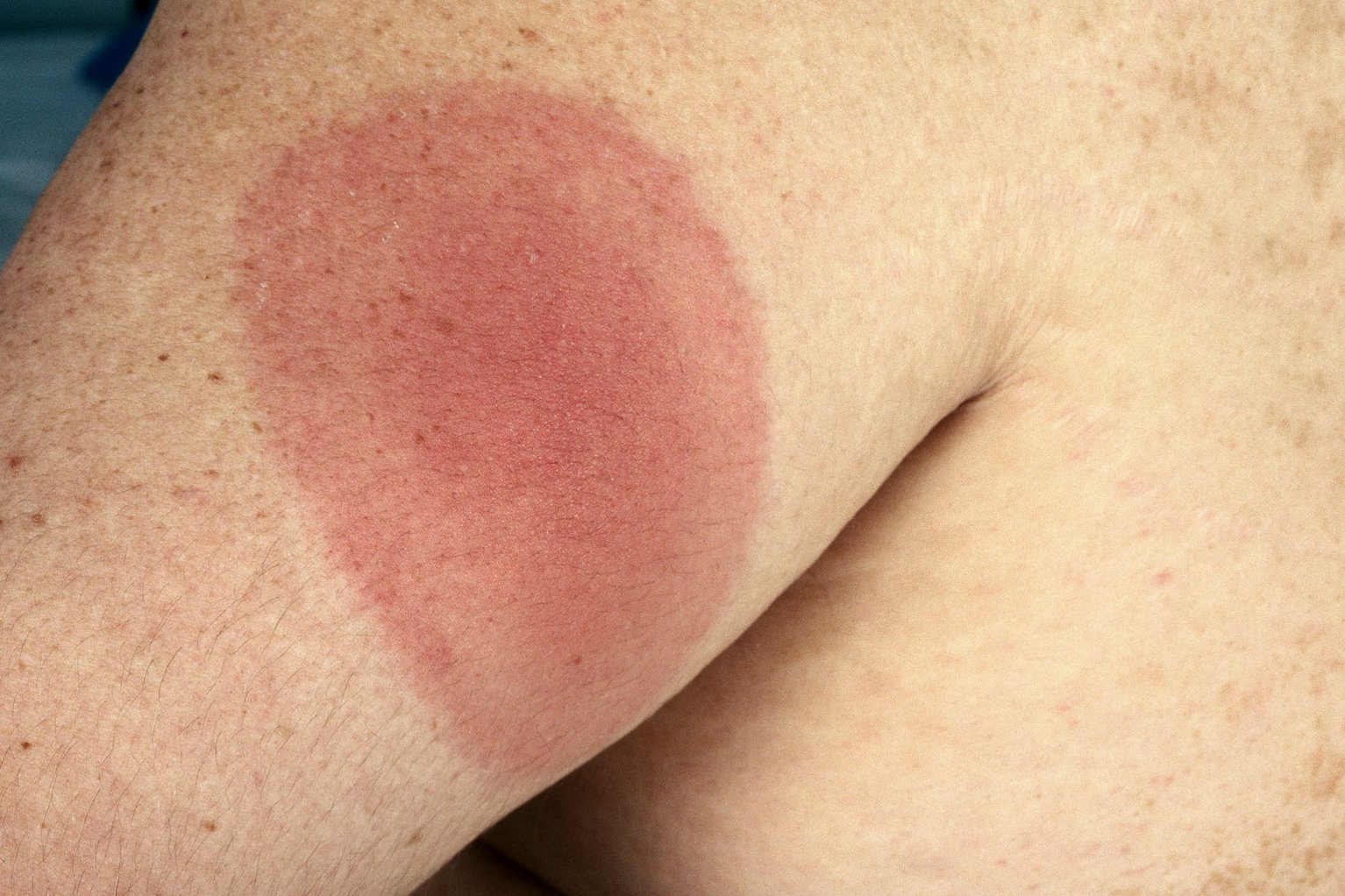 Lyme disease picture. Picture credit: Skin deep