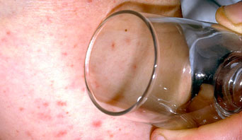 Meningitis rash shown under a glass