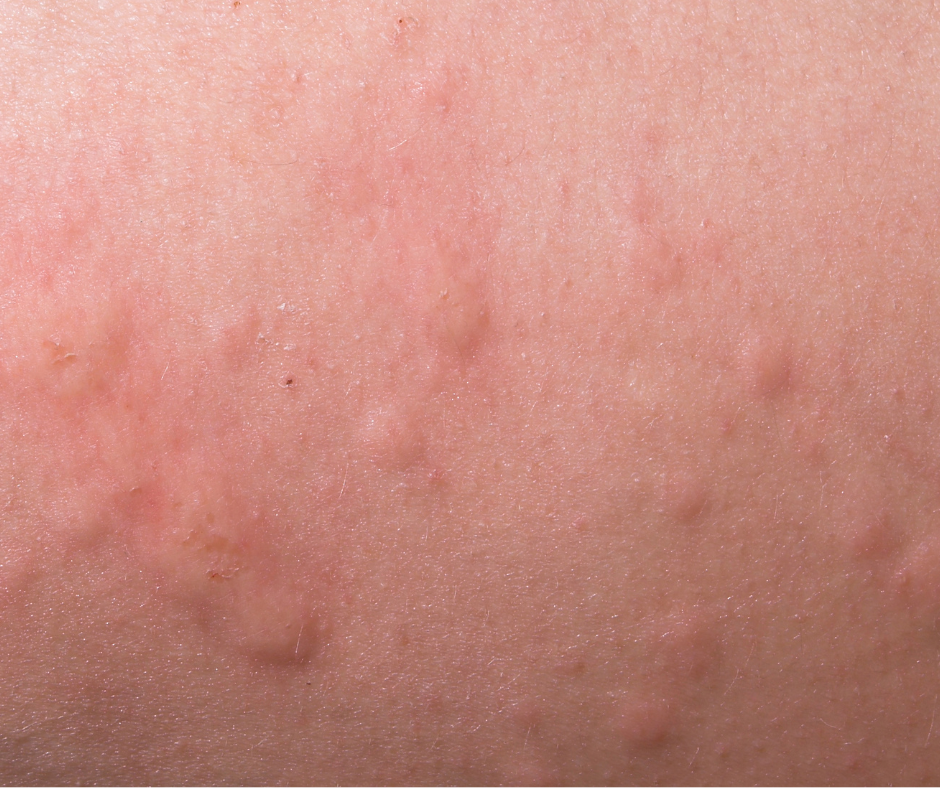 Urticaria (Hives) and Other Skin Allergies