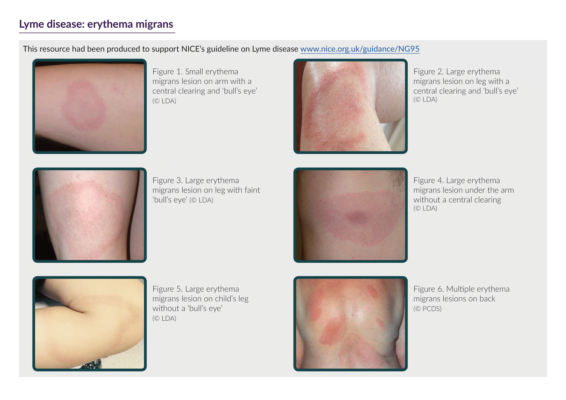 Lyme disease series of pictures