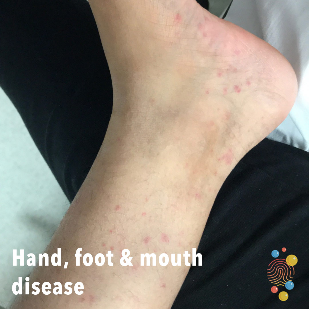 Red spots which develop into blisters appearing on white skin of bottom of leg and foot