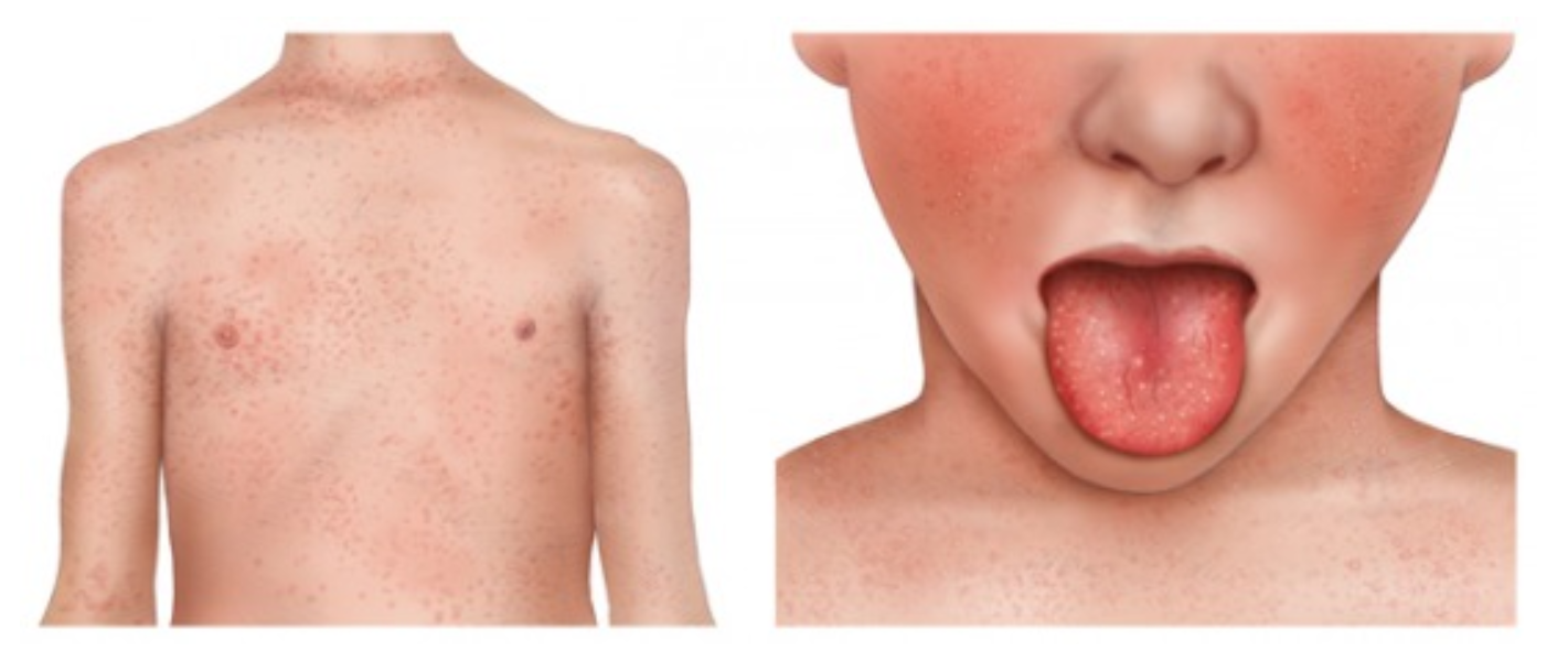 How to spot tell-tale scarlet fever rash as cases soar and 6 kids die in  Strep A outbreak