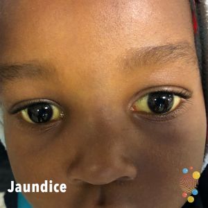 Black skin child with jaundice - yellow eyes