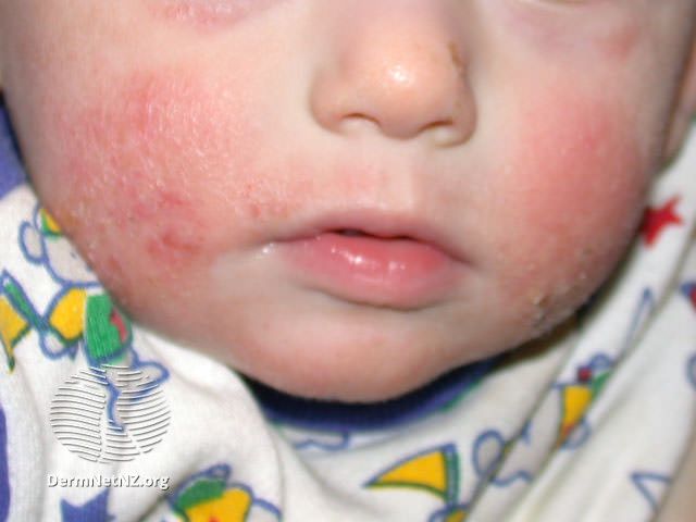 Infant_atopic_dermatitis_on_the_cheeks.jpg